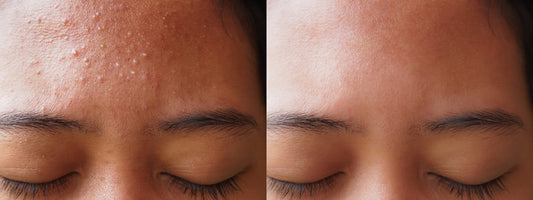 Soothing Sensitive Skin: A Gentle Approach with Bruno's Glam